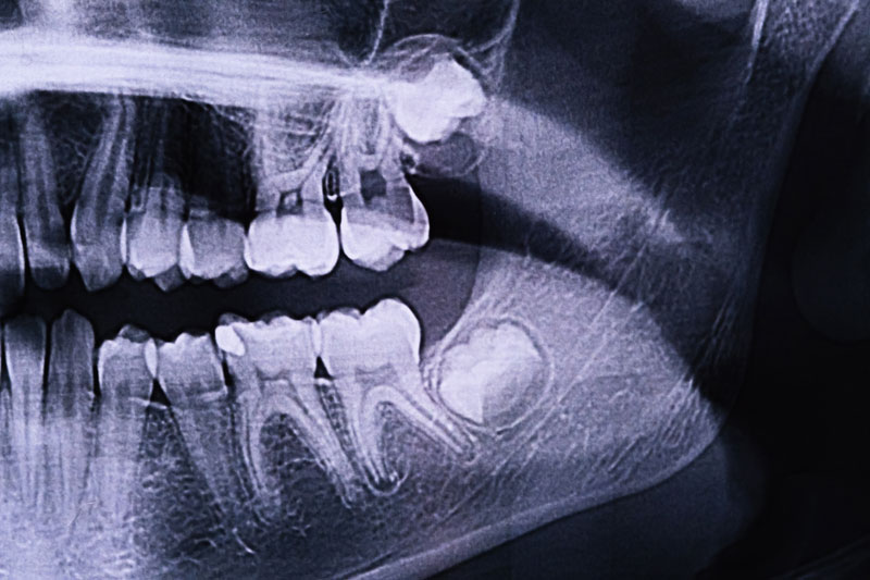 Wisdom Teeth Symptoms 