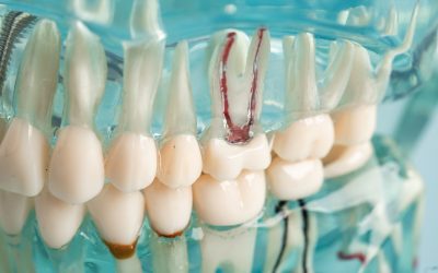 Comprehensive Guide to Root Canal Therapy: Indications, Post-Treatment Care, Post-Treatment Driving and Essential Recovery Tips